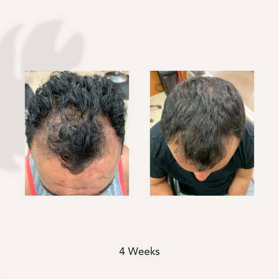 4 Weeks before and after showing dramatically reduced hair thinning and hair loss from using Actiiv Recover Thickening Shampoo for Men
